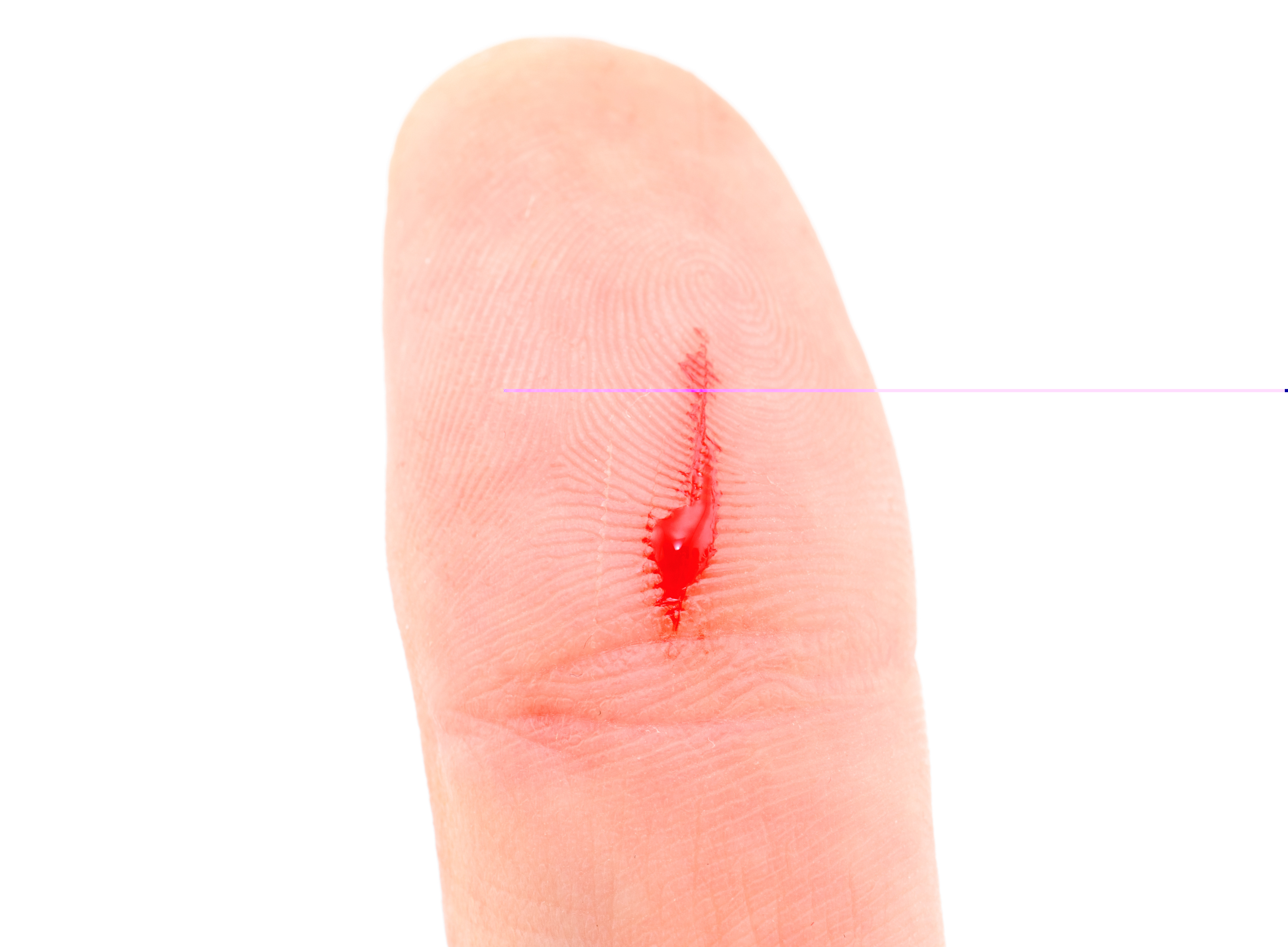 #241 La sangre en la oreja, el pulgar y el dedo gordo